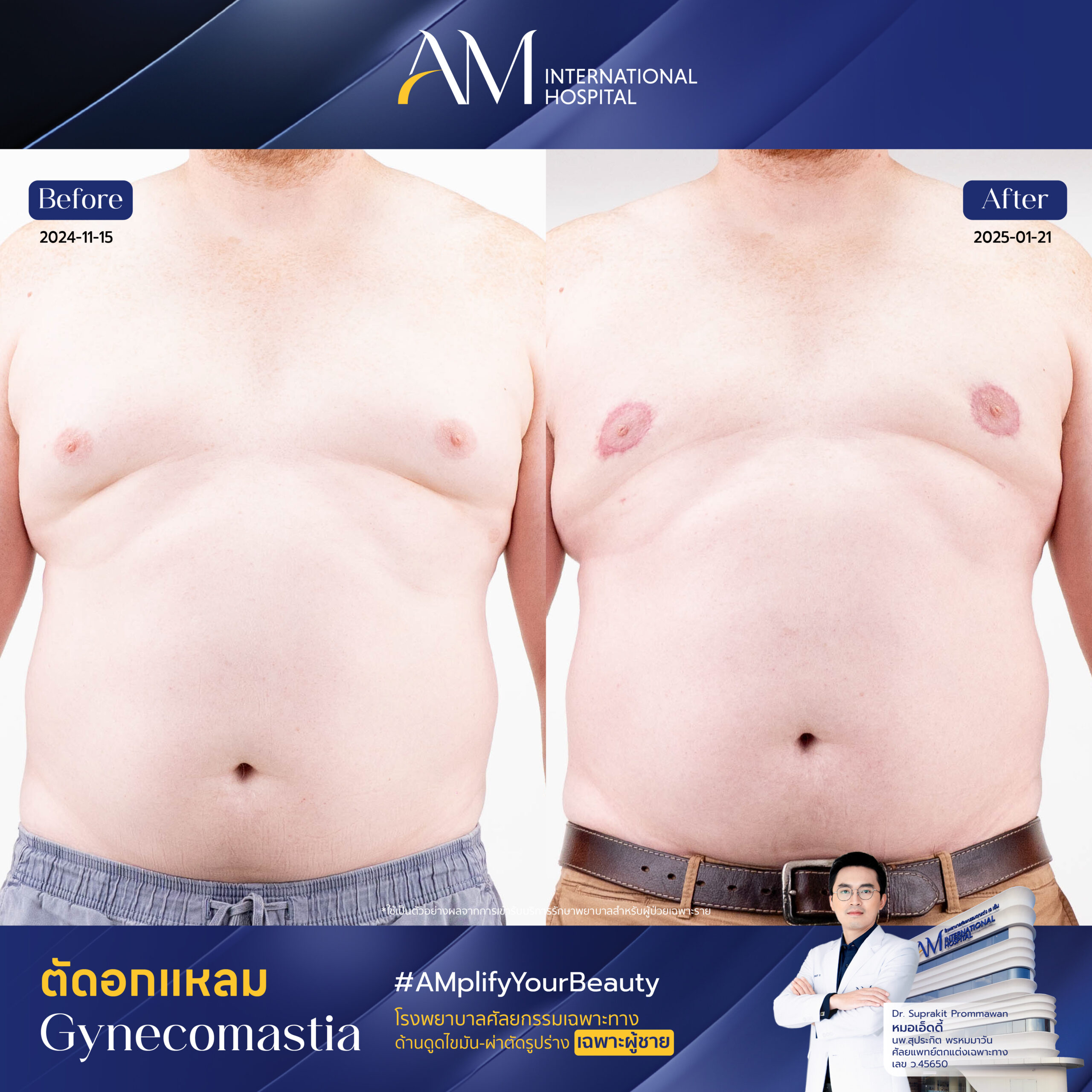 15135 Kevin ตัดหน้าอก-01